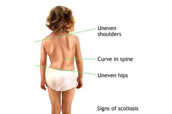 Scoliosis